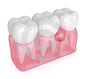 3d render of teeth in gums with cyst