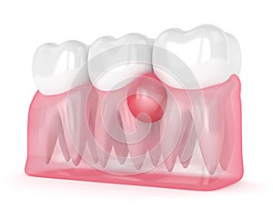 3d render of teeth in gums with cyst