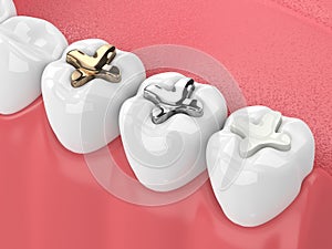 3d render of teeth with inlay