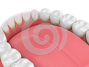 3d render of teeth with plaque and tartar