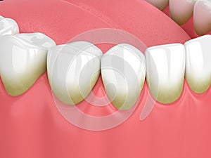 3d render of teeth with plaque and tartar