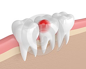 3d render of teeth with toothache in gums