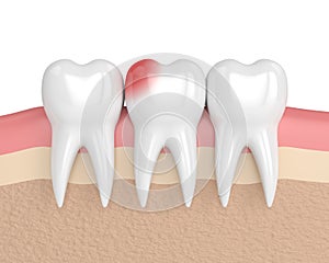 3d render of teeth with toothache in gums