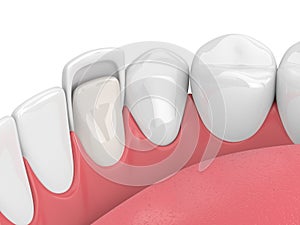 3d render of teeth with veneer