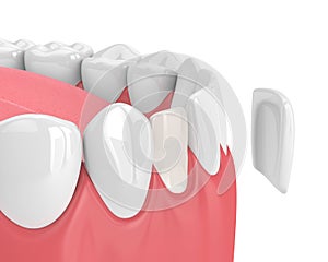 3d render of teeth with veneer