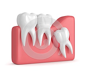 3d render of teeth with wisdom cyst