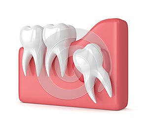 3d render of teeth with wisdom cyst