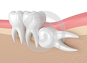 3d render of teeth with wisdom horizontal impaction