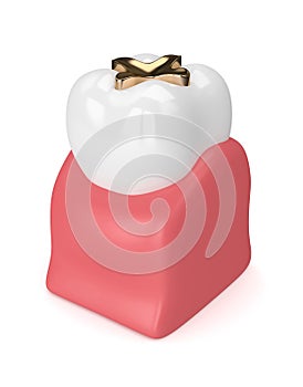 3d render of tooth with dental golden inlay filling