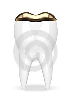 3d render of tooth with dental golden onlay filling