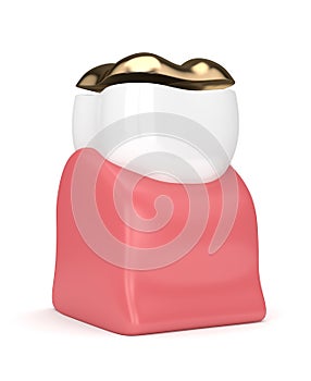 3d render of tooth with dental golden onlay filling