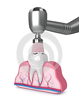 3d render of tooth with dental handpiece and polishing brush