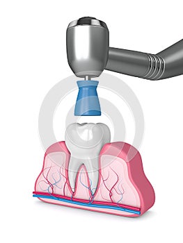 3d render of tooth with dental handpiece and polishing prophy cup