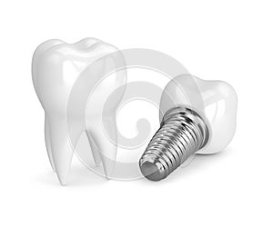 3d render of tooth with dental implant