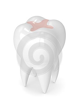 3d render of tooth with dental inlay filling