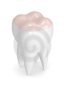 3d render of tooth with dental onlay filling