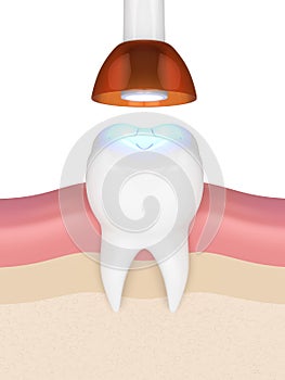 3d render of tooth with dental polymerization lamp and light cured inlay