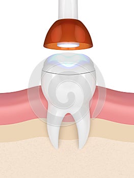 3d render of tooth with dental polymerization lamp and light cured onlay