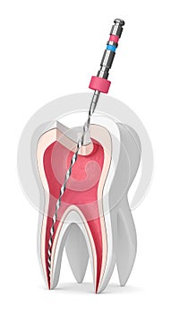 3d render of tooth with endodontic file