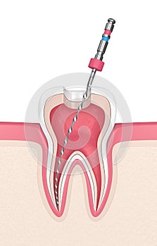 3d render of tooth with endodontic file in gums