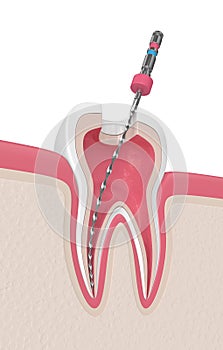 3d render of tooth with endodontic file in gums