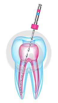 3d render of tooth with endodontic file over white background