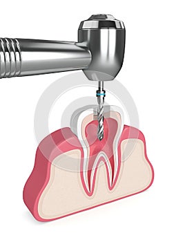 3d render of tooth in gums with dental drill