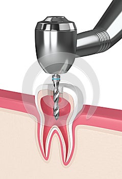 3d render of tooth in gums with dental drill