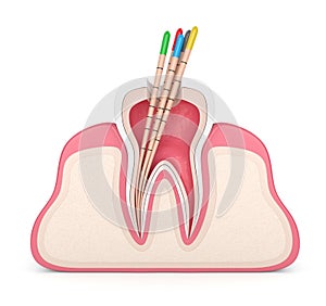 3d render of tooth in gums with gutta percha