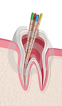 3d render of tooth in gums with gutta percha