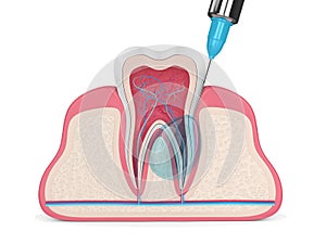 3d render of tooth in gums with intraligamentary anesthesia procedure