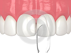 3d render of tooth reshaped by composite resin adm matrix over white