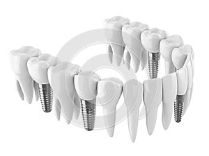 3d render of toothing with dental implants