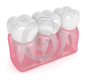 3d render of translucent gums with cracked tooth