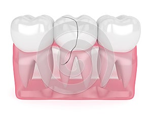 3d render of translucent gums with cracked tooth
