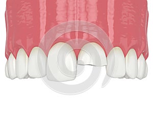 3d render of upper jaw with broken incisor tooth