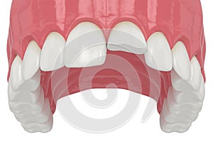 3d render of upper jaw with broken incisor tooth