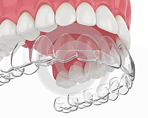 3d render of upper jaw with invisalign removable retainer