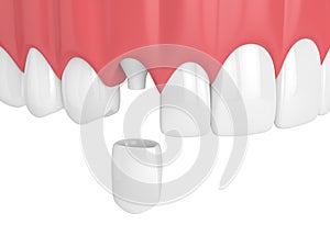 3d render of upper jaw with teeth and dental canine crown