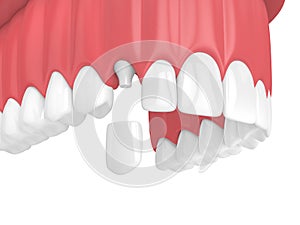 3d render of upper jaw with teeth and dental canine crown