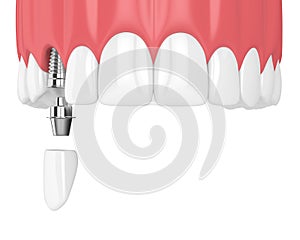 3d render of upper jaw with teeth and dental canine implant