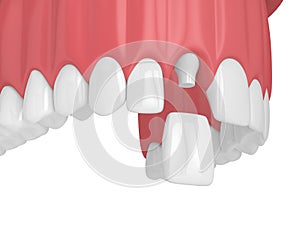 3d render of upper jaw with teeth and dental incisor crown