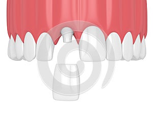 3d render of upper jaw with teeth and dental incisor crown