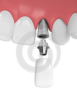 3d render of upper jaw with teeth and dental lateral incisor imp