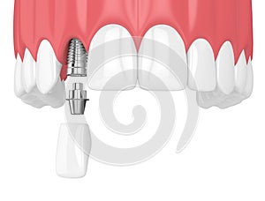 3d render of upper jaw with teeth and dental lateral incisor imp