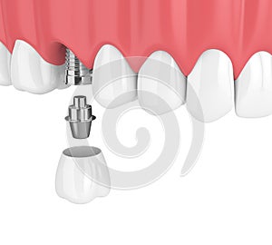 3d render of upper jaw with teeth and dental molar implant