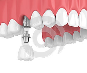 3d render of upper jaw with teeth and dental molar implant