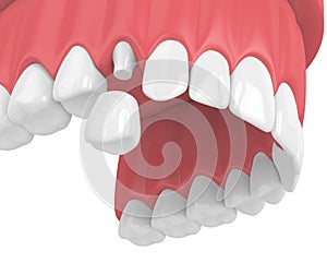 3d render of upper jaw with teeth and dental premolar crown