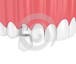 3d render of upper jaw with teeth and dental premolar crown