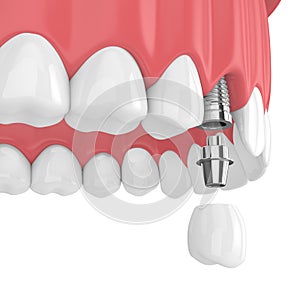 3d render of upper jaw with teeth and dental premolar implant